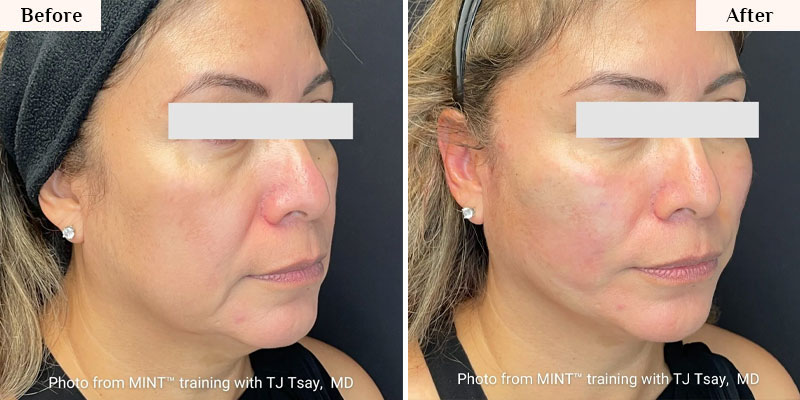 pdo thread lift before after